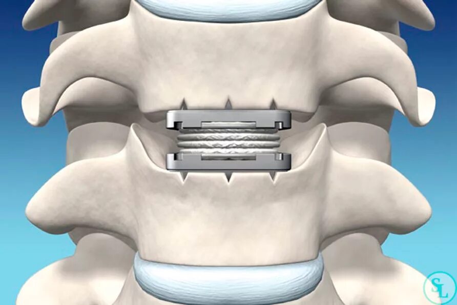 Операция по замене позвоночника. Эндопротез межпозвонкового диска m6. Протез межпозвонкового диска m6 l. Кейдж Солис межпозвонковый. Имплант межпозвонкового диска м6.