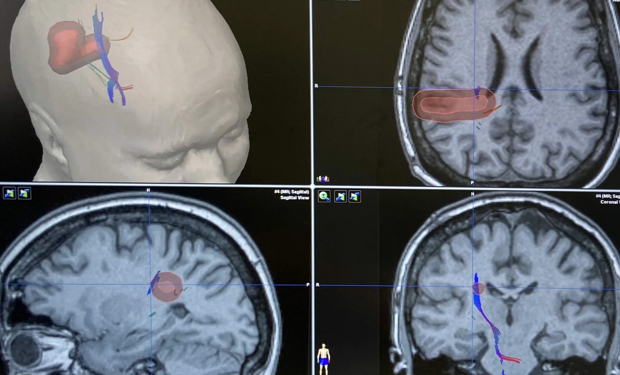 Червишевский тракт 4 тюмень федеральный нейрохирургия. Резервуар Оммайя для нейрохирургии что это. Нейрохирургия эпилепсия.
