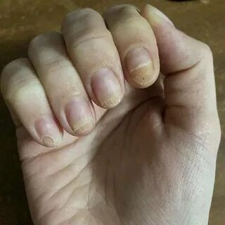 Лосьон стоп онихолизис