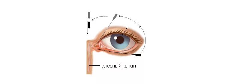 Чистка слезных каналов. Бужирование слезного мешка. Дакриоцистит зондирование канала. Непроходимость слезного канала зондирование. Расширение слезного канала у новорожденных.