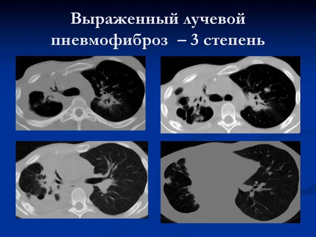Постлучевой пневмофиброз кт. Лучевой фиброз легких кт.