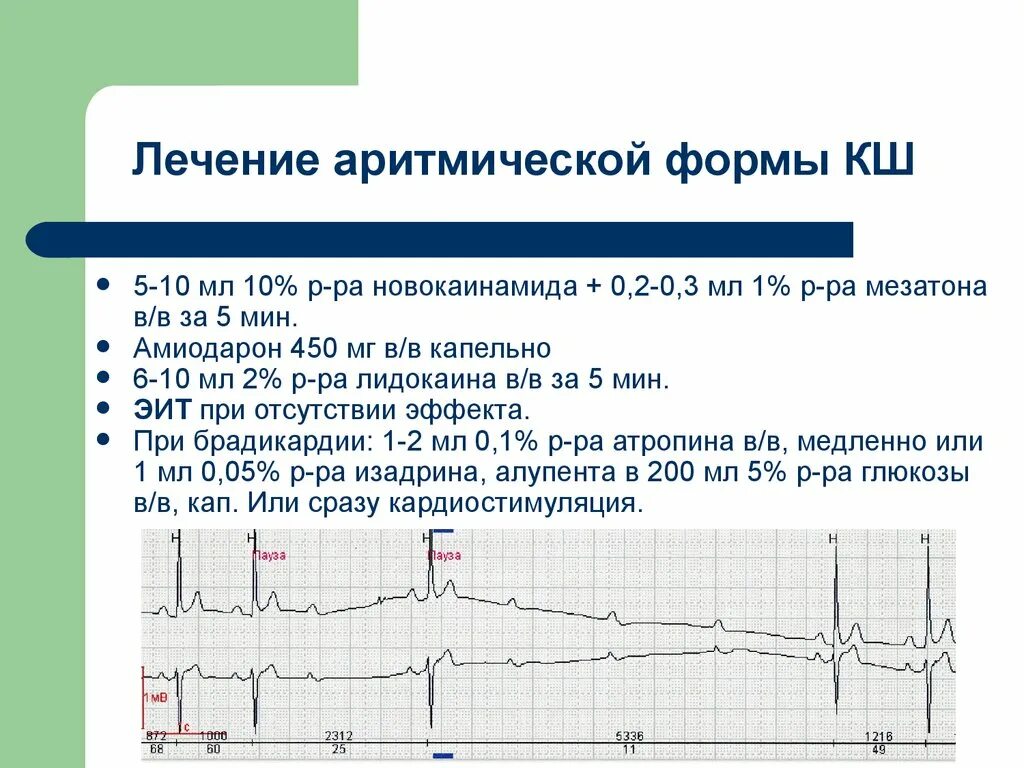 ЭКГ при кардиогенном шоке. Кардиогенный ШОК на ЭКГ. Аритмическая форма инфаркта миокарда. Аритмический кардиогенный ШОК.