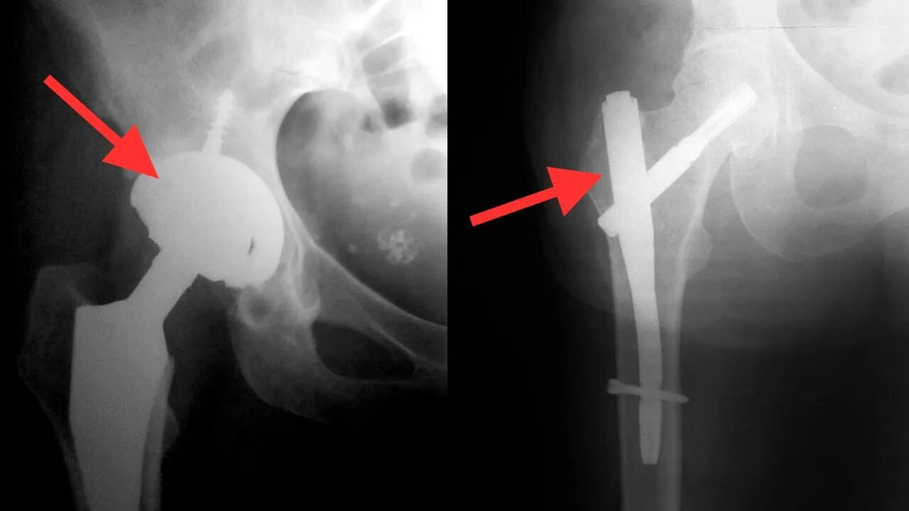 Последствия перелома шейки бедра. Перелом головки бедренной кости рентген. Перелом шейки бедра рентген. Рентген диагностика перелома шейки бедренной кости. Рентген кости операции перелома шейки бедра.