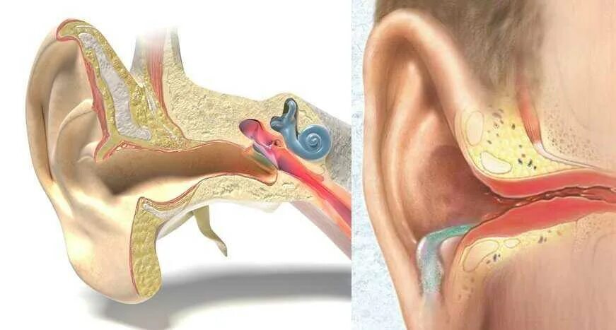 Почему воспаление среднего уха. Евстахиит барабанная перепонка. Хронический отит наружного уха.