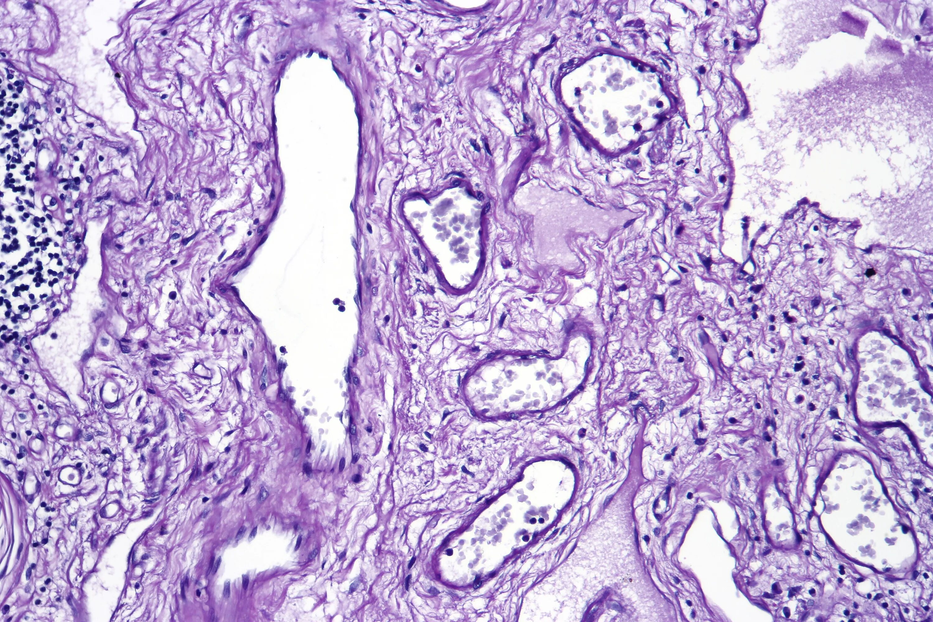 Angiectasia латынь