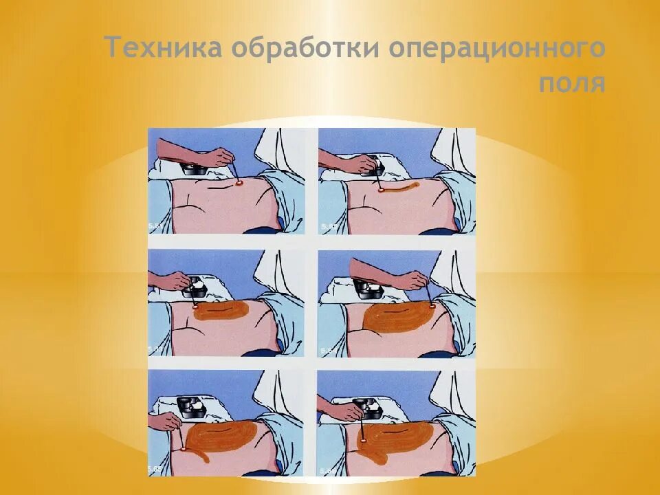 Алгоритм операционного поля. Методика обработки операционного поля. Обработка операционного поля йодонатом. Обработка операционного поля схема. Методы подготовки операционного поля.