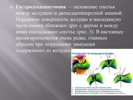 Дренирующие операции на желудке