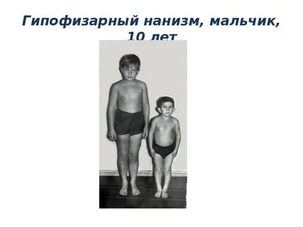 Карликовость щитовидная железа