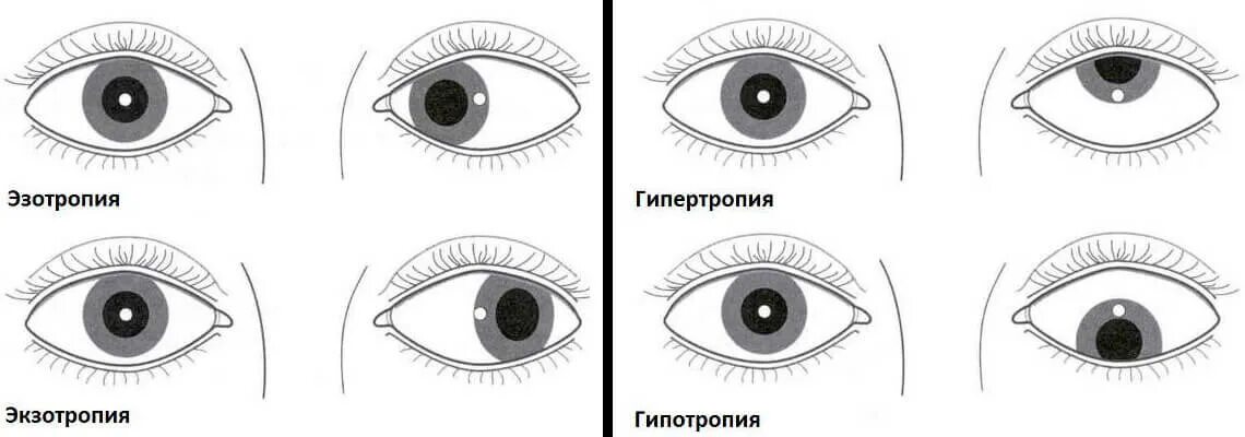 Косит глаз причины. Паралитическое вертикальное косоглазие. Косоглазие степень зрения. Схема паралитического косоглазия. Экзотропия расходящееся косоглазие.