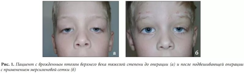 Птоз верхнего века у ребенка операция. Птоз верхнего века у грудничка. Двусторонний птоз век у новорожденных. Веко верхнее птоз 1 степени. Врожденный птоз