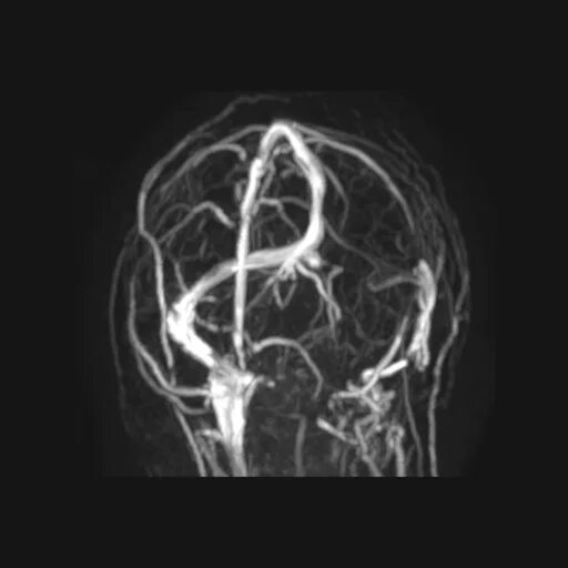 Гипоплазия правого поперечного синуса. Гипоплазия левого поперечного синуса. Мрт. Тромбоз поперечного синуса радиография. Аплазия позвоночной артерии. Аплазия поперечного синуса мрт.