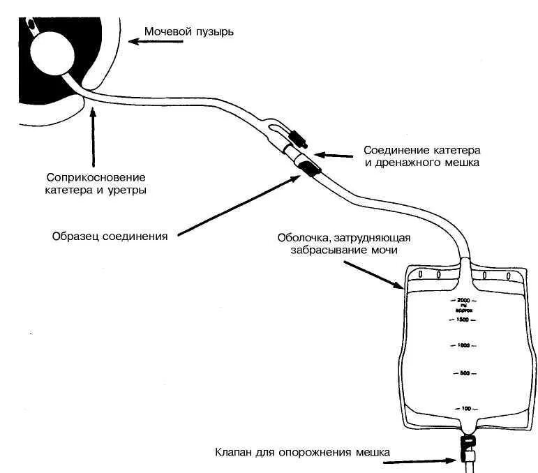 Сколько может стоять катетер в мочевом пузыре. Постоянный мочевой катетер строение. Катетер схема. Схема катетера для мочевого пузыря.