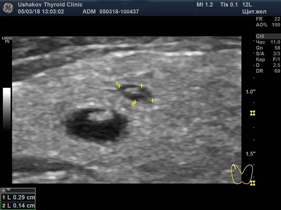 Анэхогенный узел щитовидной железы. УЗИ щитовидной железы ti-rads2. Коллоидные кисты щитовидной железы на УЗИ. УЗИ ti rads 4б.