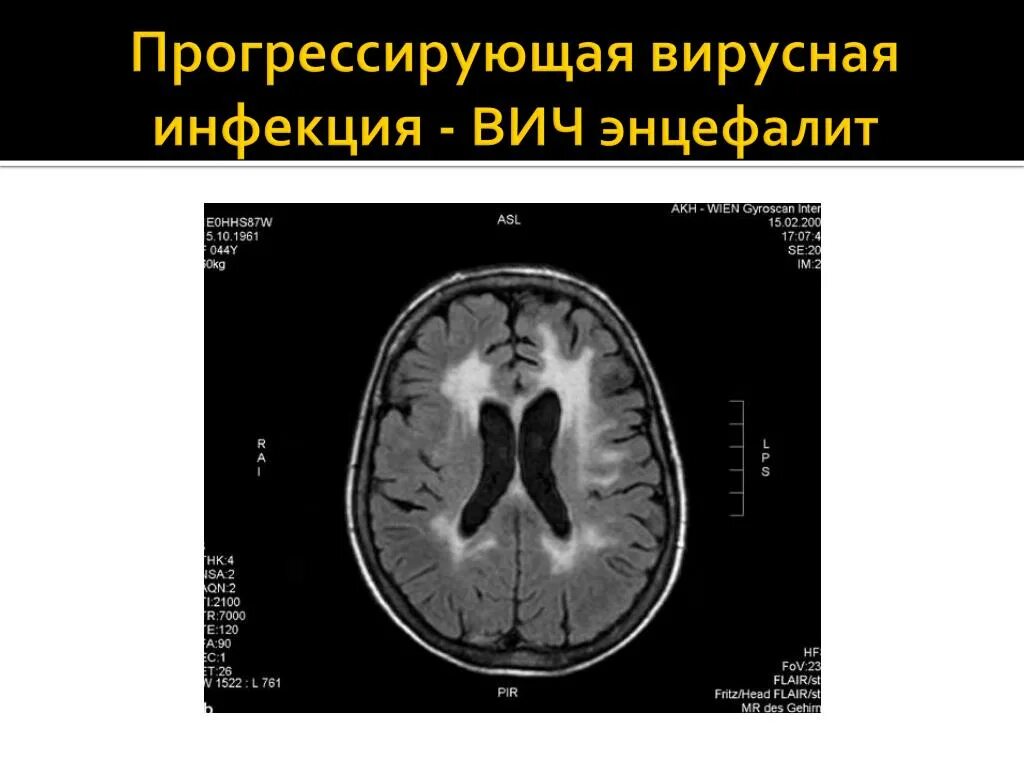 Энцефалит головного мозга симптомы у взрослых. Гриппозный энцефалит мрт. герпетический энцефалит кт.