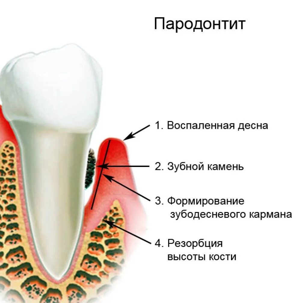 Костная основа полости рта. Хронический пародонтит зубная формула. Здоровый зуб гингивит пародонтит. Гингивит пародонтит пародонтоз классификация.