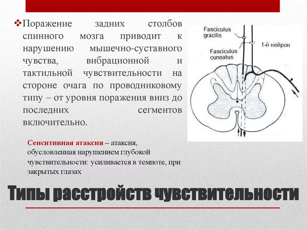 Передний столб спинного мозга. Поражение задних столбов спинного мозга. Синдром поражения задних столбов спинного мозга. Синдром поражения задних столбов. Передние задние боковые столбы спинного мозга.