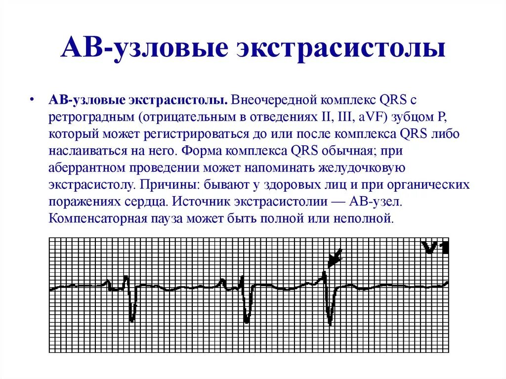 АВ Узловая экстрасистолия на ЭКГ. Экстрасистолия из АВ соединения. Атриовентрикулярная экстрасистолия на ЭКГ. Экстрасистолы из av соединения. Экстрасистолы врачам