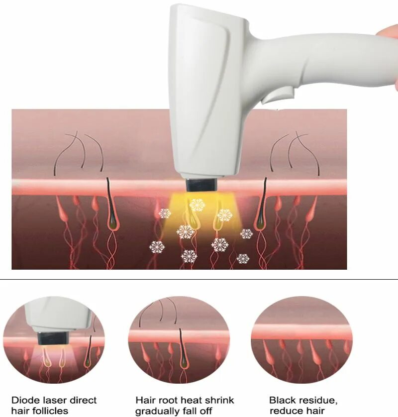 Светлые волосы удалить лазером. Принцип действия лазера для эпиляции. Аппарат элос диодный лазер. Мужчина lazer epilyaciya. Лазерная эпиляция лица для женщин.