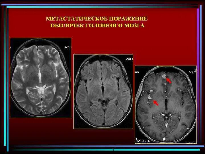 Поражение оболочек мозга. Метастатическое поражение головного мозга кт. Лучевая диагностика опухолей головного мозга. Рентгенология головного мозга. Метастатическое поражение головного мозга мрт.