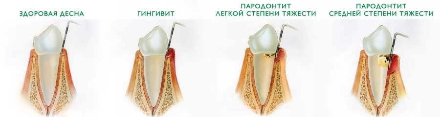 Воспаление десен пародонтит. Некротический гингивит Венсана. Десквамативный гингивит.