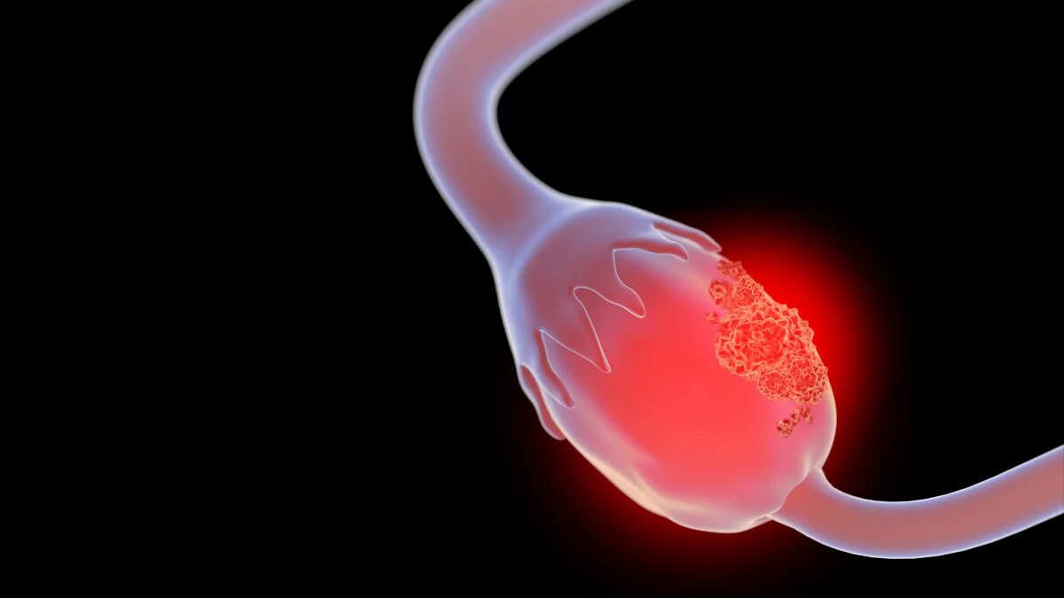 Онкология яичников наследственные.