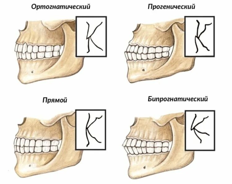 Правильное расположение челюсти сбоку. Правильный прикус зубов сбоку. Ортогнатический прикус для передних зубов. Ортогнатический прикус постановка зубов. Что значит тяжелая операция