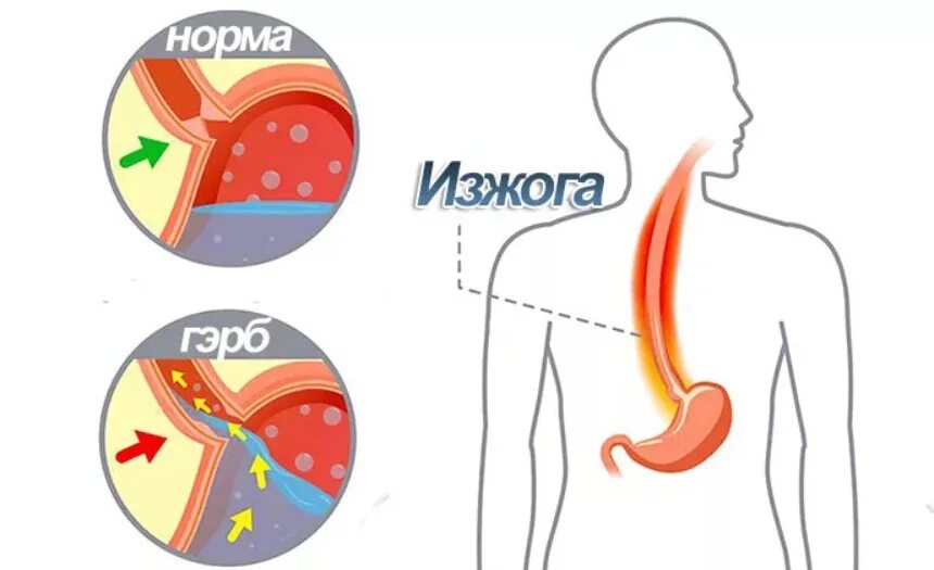 Почему изжога что делать. Изжога причины.