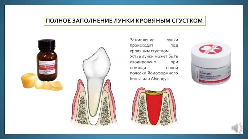 После удаления зуба можно ли пить воду. Заживление удаленного зуба. Сгусток в лунке удалённого зуба.