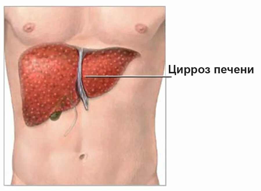 Цирроз первые признаки у женщин. Печеночные проявления цирроза печени. Печень больного циррозом печени. Цирроз печени симптомы болезни.