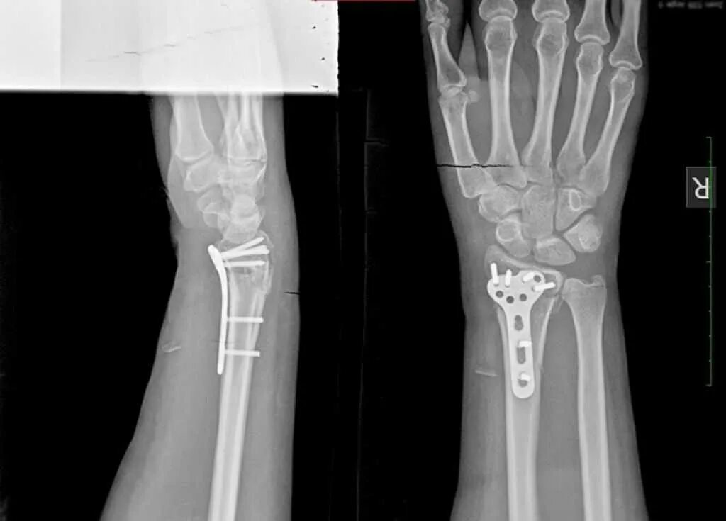 Поднадкостничный остеосинтез. Перелом лучевой кости рентген. Перелом лучевой запястной кости. Рентген оскольчатый перелом лучевой кости. Пластина в пальце