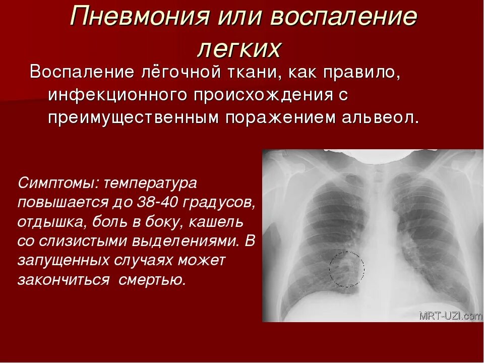 Пневмония признаки у взрослых. Пневмония симптомы. Пневмония симптомы у взрослых. Воспаление лёгких симптомы у взрослых без температуры.