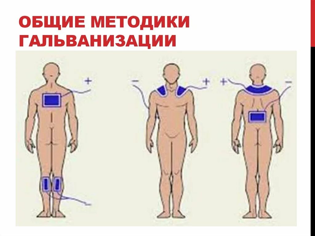 Брома на воротниковую зону. Общая гальванизация по Вермелю. Общая гальванизация и электрофорез по Вермелю. Методика Вермеля электрофорез. Методика наложения электродов при электрофорезе.