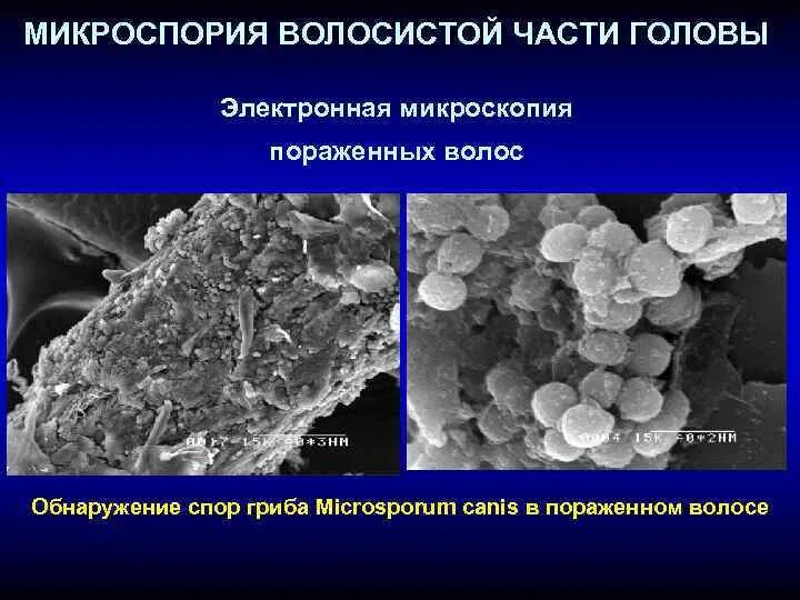 Микроспорум Канис микроскопия. Поверхностная трихофития микроскопия. На коже обнаружены споры