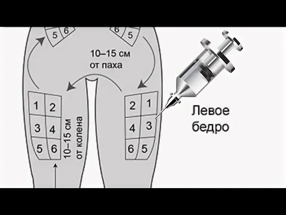 Как правильно поставить укол в бедро самостоятельно. Как правильно сделать укол внутримышечно самому себе. Схема внутримышечной инъекции в бедро. Как колоть уколы в бедро самому себе внутримышечно. Место уколов в бедро