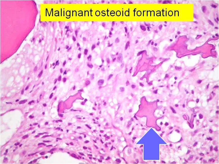Osteosarcoma метастазы. Саркома юинга бедренной кости рентген. Метастаз остеосаркомы. Метастаз остеосаркомы. Саркома бедренной кости мрт.