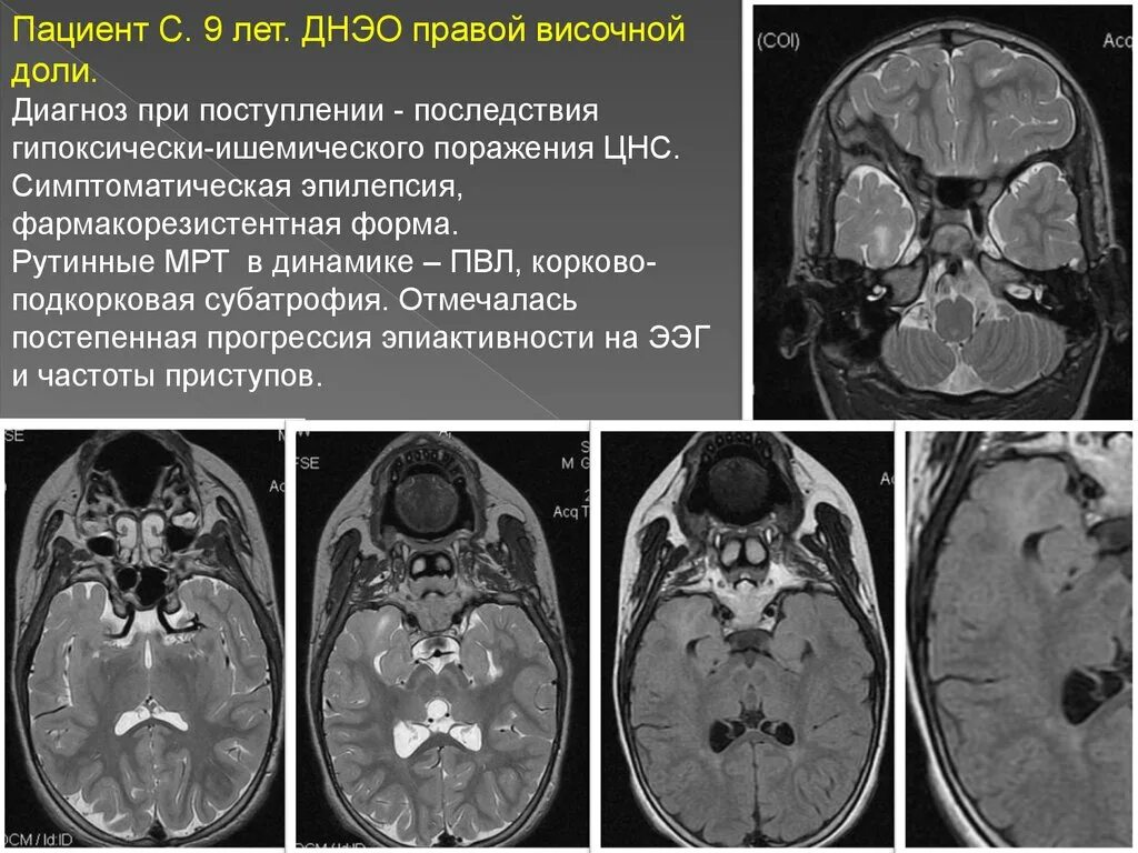 Ишемически гипоксическое поражение головного. Мрт ДНЭО височной доли. Эпилепсия мрт височных долей.