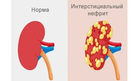 Нефрит почек причины