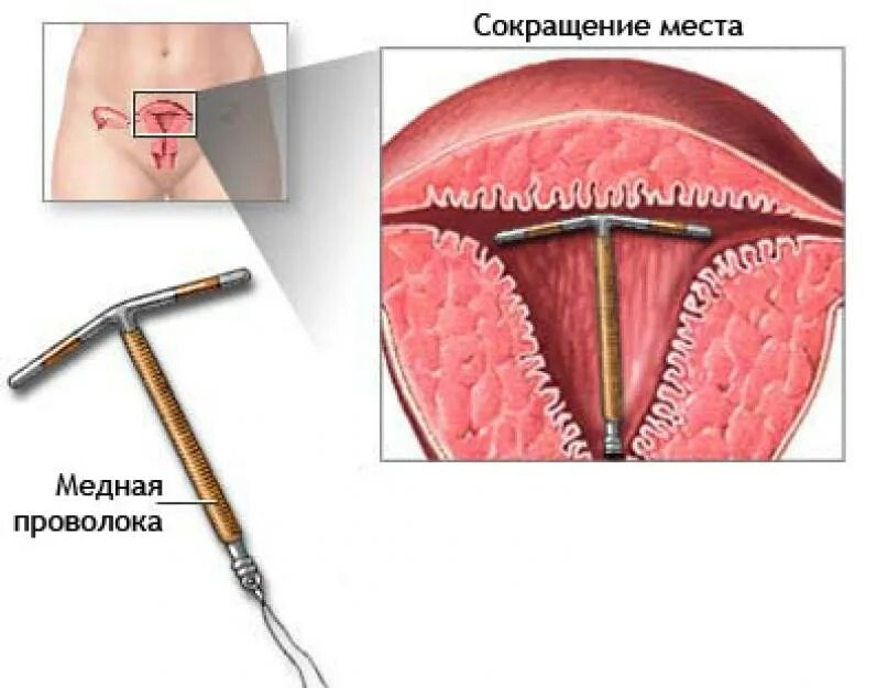 Удаление вмс код. Вмс внутриматочная спираль. медная спираль внутриматочная. спираль вмс мирена.