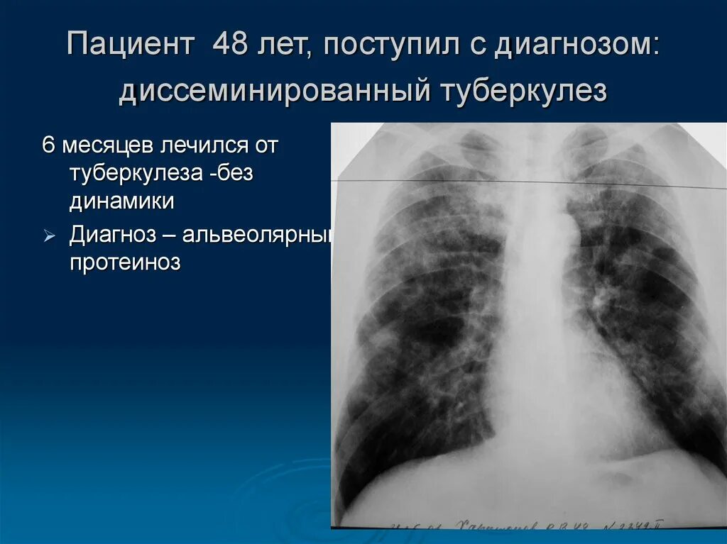 Диссеминированный туберкулез диагноз. Лечится ли туберкулез полностью.