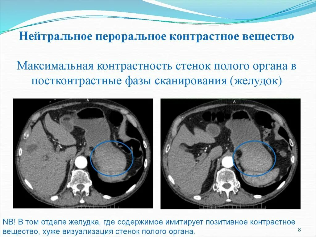 Чем характеризовался усиливавшийся контраст. Контрастные вещества для кт. Контрастное вещество при кт. Компьютерная томография с контрастным веществом. Введение контрастного вещества при кт.