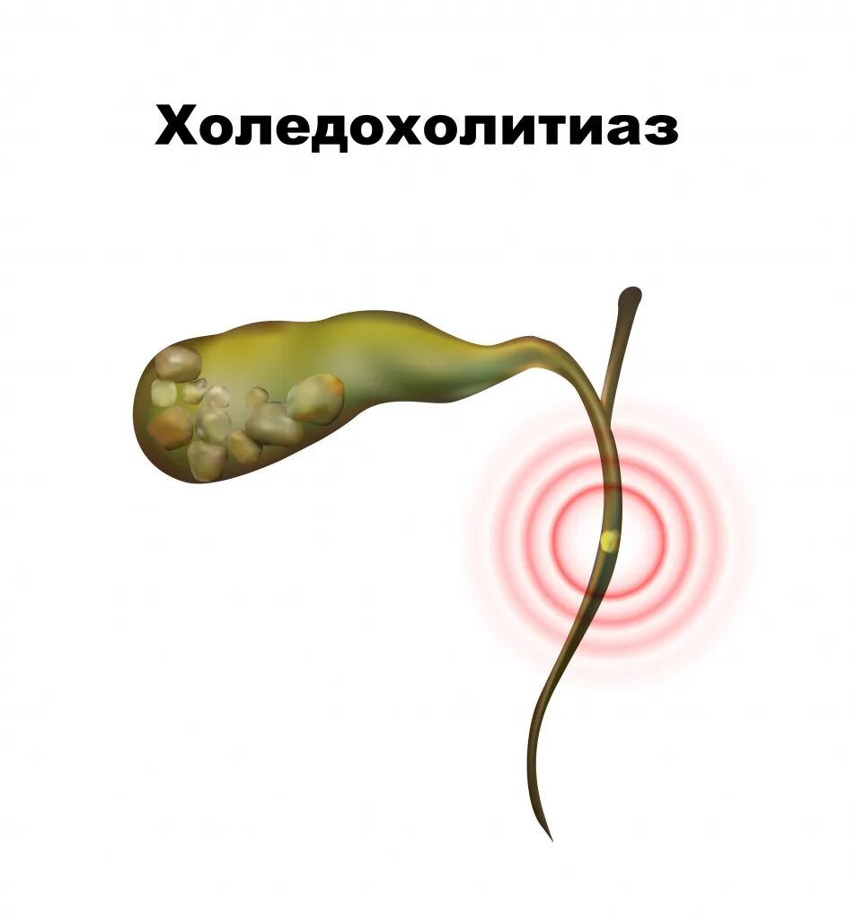 Холецистит презентация. Холецистит холедохолитиаз. Холецистит холедохолитиаз. Ультразвуковая семиотика. Желчекаменная болезнь холедохолитиаз.
