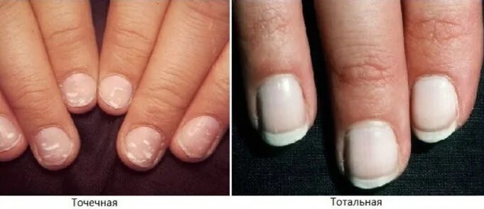 Что это такое белое на ногтях. Микотическая лейконихия. Микотическая лейконихия. Что это такое белое на ногтях. Что это такое белое на ногтях.