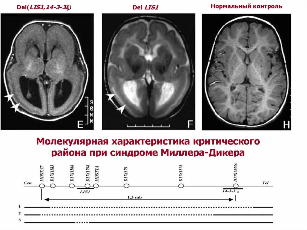 Миллера дикера. Лиссэнцефалия и синдром Миллера Дикера. Синдром Миллера Дикера мрт. Синдром Миллера Дикера симптомы. Синдром Миллера Дикера фото.