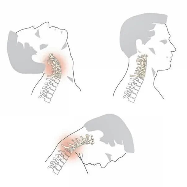 Хлыстовой перелом шейного отдела позвоночника. Хлыстовой перелом шейного отдела. Как понять что сломал шею. Перелом шейных позвоноко. Хлыстовой перелом шейных позвонков.