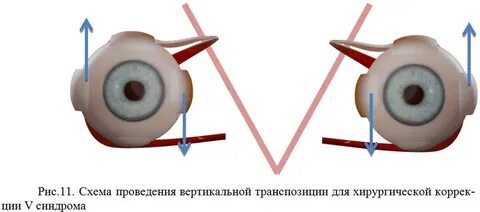 Транспозиция линз