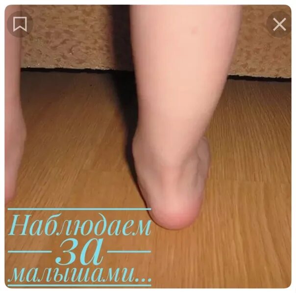 Вальгусные стопы 5 лет. Плоскостопие вальгусная стопа. вальгус стопы у ребенка 7 лет. вальгусная деформация стопы у ребенка 7 лет.