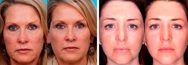 элос омоложение фото. фотоомоложение лица элос. фотоомоложение до и после. процедура фотоомоложения лица. неаблятивное лазерное омоложение.