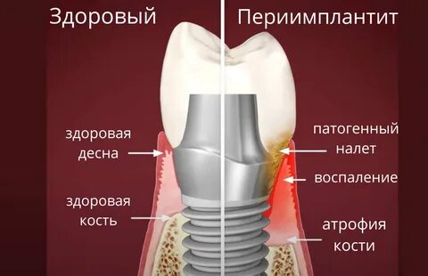 Имплант может болеть