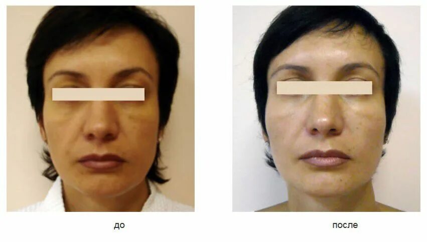 Липофилинг полового. Фильтр для шприцев липофилинг. Контурная пластика губ на тонкие губы. Липофилинг полового. Липофилинг подбородка.