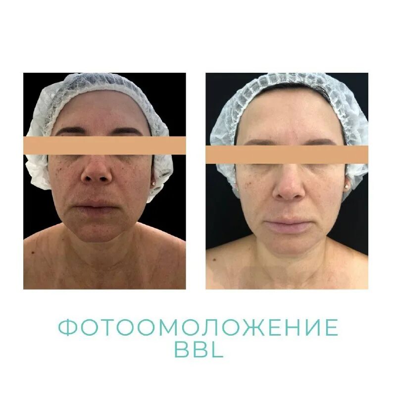 пациентка 45. 3 день после блефаропластика верхних век. пациентка 45. клиника лазера студенческая. комплексная пластика.